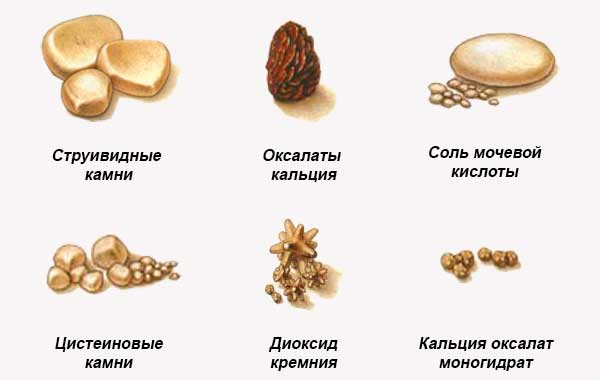 Виды почечных камней